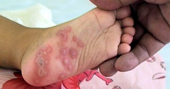 Bệnh tay chân miệng vào mùa: Những điều cần biết