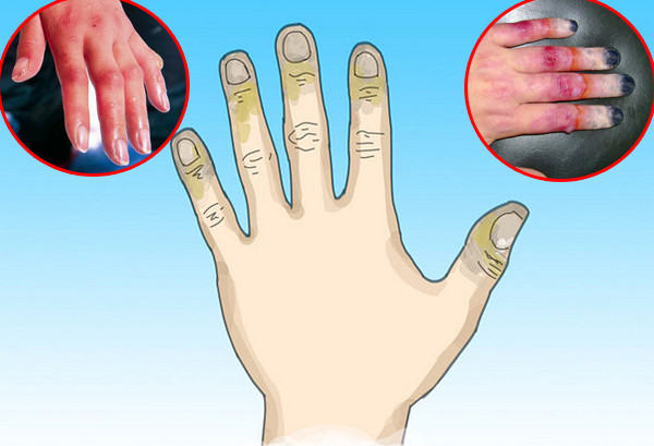 Người bị bỏng lạnh cấp độ 2. Người bị bỏng lạnh cấp độ 2.