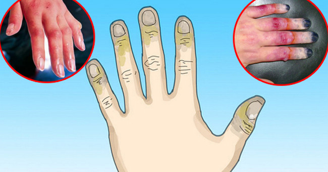 Cách chữa trị cho người bị bỏng lạnh