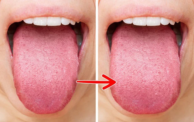 luoi-beo-len Lưỡi của bạn có thể bị béo lên