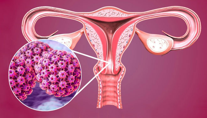 ung-thu-co-tu-cung Các bệnh nhân mắc ung thư cổ tử cung đa phần có tiền sử nhiễm virus HPV.