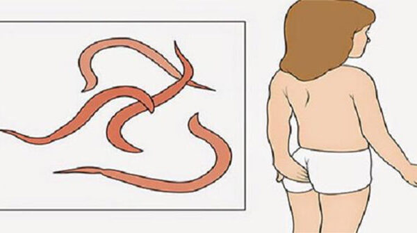Cách bắt giun kim cho trẻ em không cần dùng thuốc cha mẹ nên biết